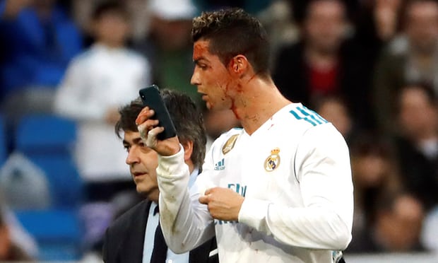 Bị chảy máu đầu Ronaldo vẫn quan tâm đến nhan sắc